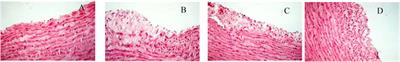 Therapeutic Effect and Mechanism of Si-Miao-Yong-An-Tang on Thromboangiitis Obliterans Based on the Urine Metabolomics Approach